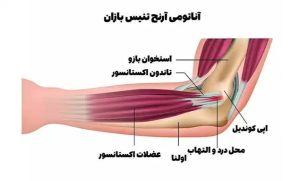 آرنج تنیس بازان چیست و فیزیوتراپی چه نقشی در کاهش درد بیرون آرنج دارد