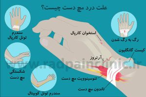 سندرم تونل کارپال چیست و فیزیوتراپی چه نقشی در کاهش خواب رفتن دست دارد