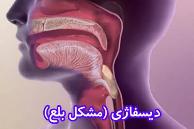 اختلال بلع یا دیسفاژی و نقش گفتاردرمانگر در ارزیابی و درمان مشکلات بلع

