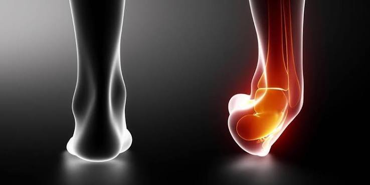 پیچ خوردگی مچ پا چیست و فیزیوتراپی چه نقشی در کاهش درد و برگشت به راه رفتن دارد